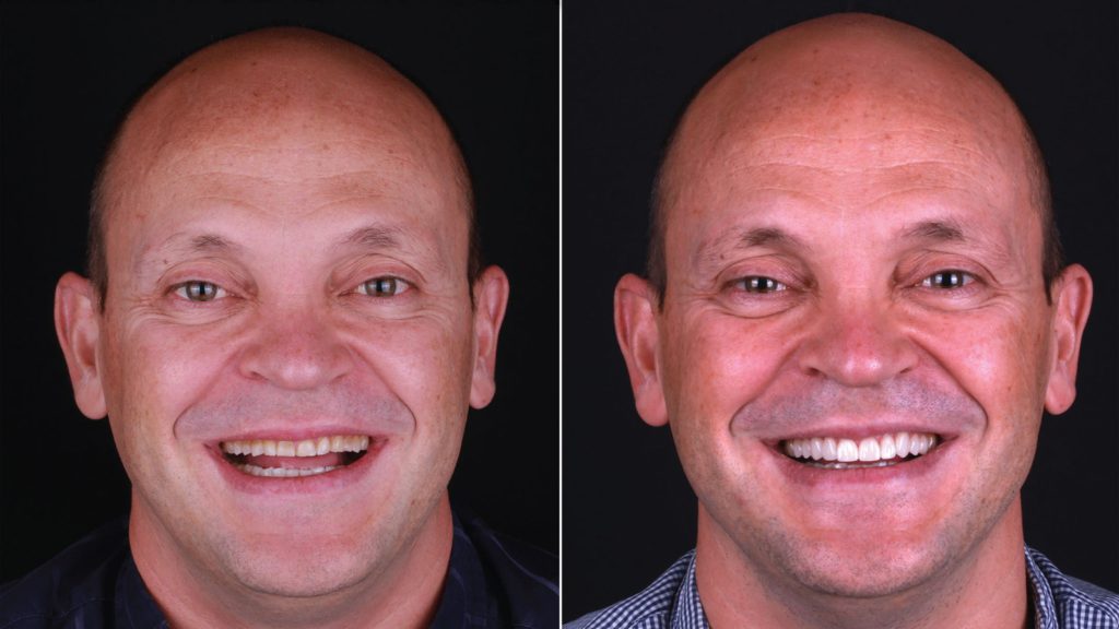 FirstFit En Clínica Dental Cuevas Queipo - mejora la sonrisa en solo 2 citas