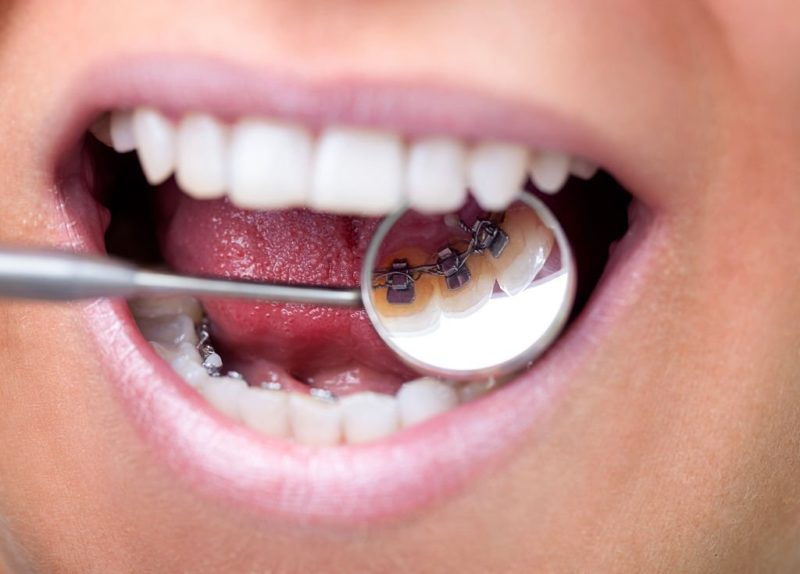 revisión ortodoncia lingual en dientes perfectos